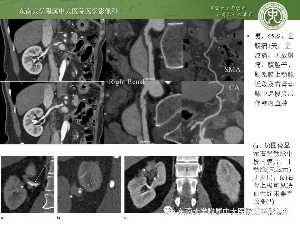 影像PPT - 【PPT】肾动脉常见病变-19