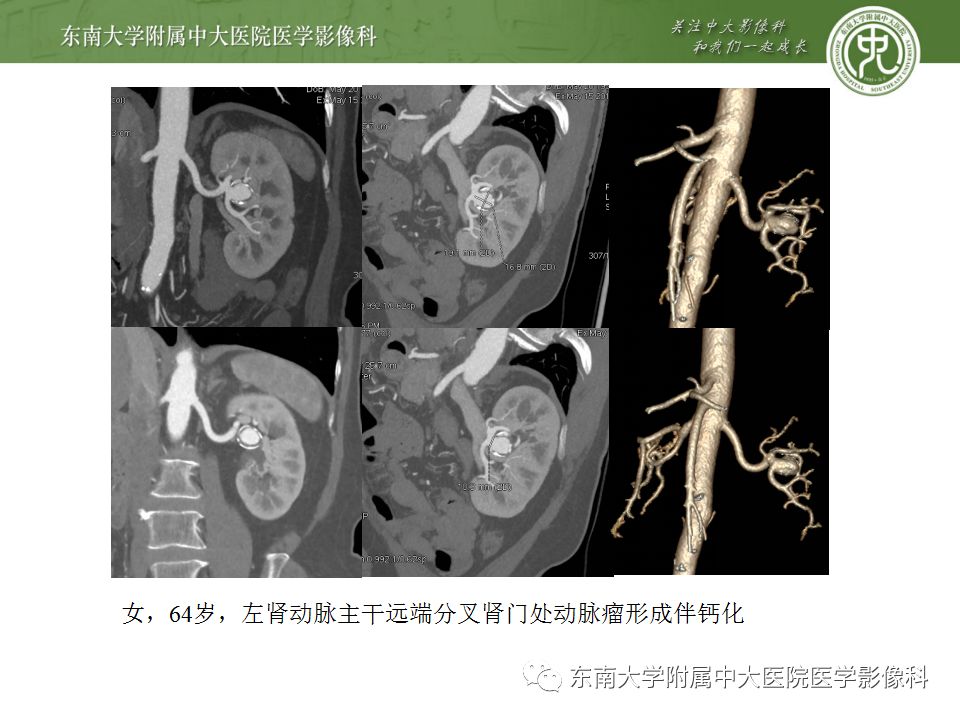 影像PPT - 【PPT】肾动脉常见病变-21