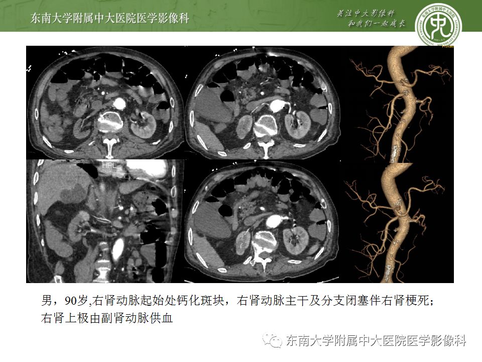 影像PPT - 【PPT】肾动脉常见病变-23