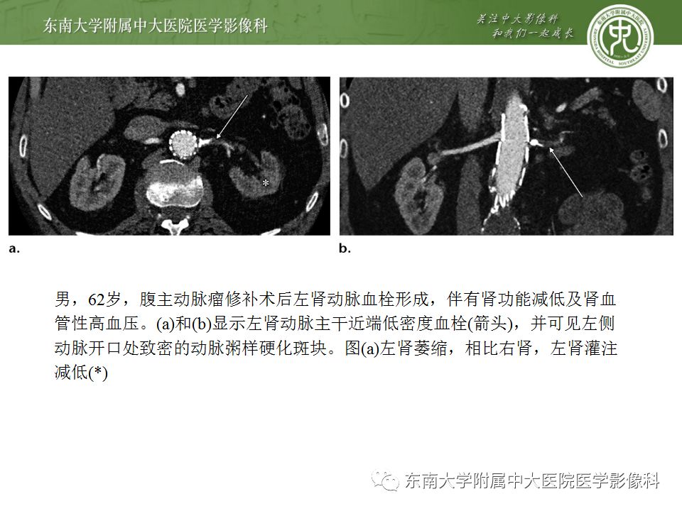 影像PPT - 【PPT】肾动脉常见病变-24