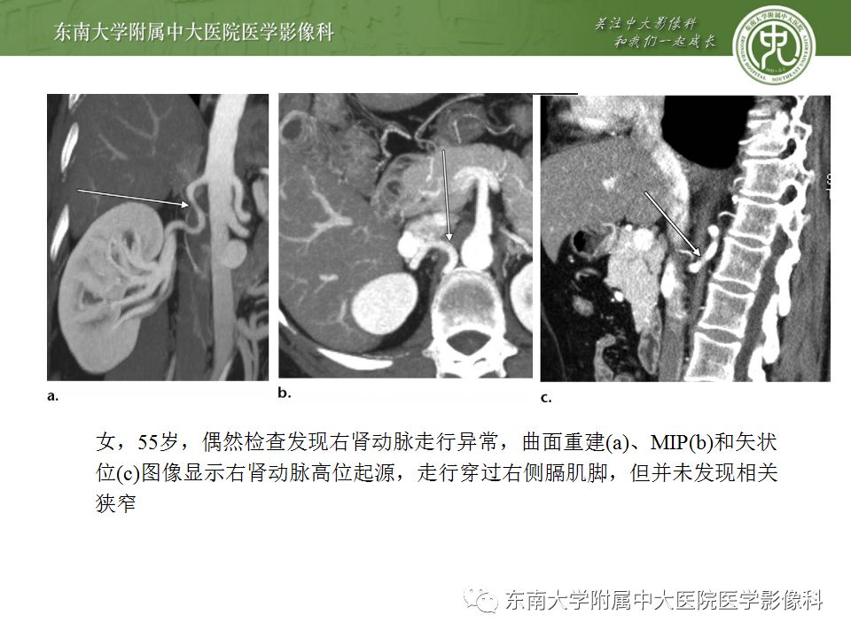 影像PPT - 【PPT】肾动脉常见病变-26
