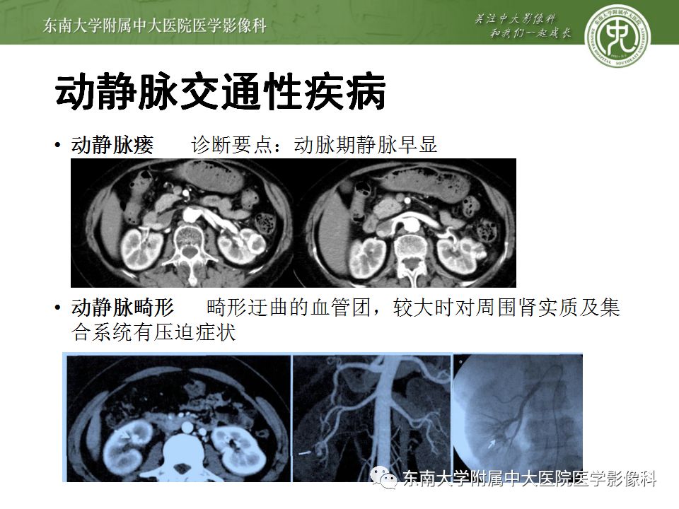 影像PPT - 【PPT】肾动脉常见病变-27
