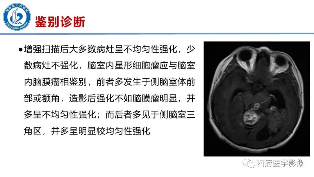影像PPT - 【病例】脑室系统脑膜瘤1例CT及MR影像表现与鉴别-17