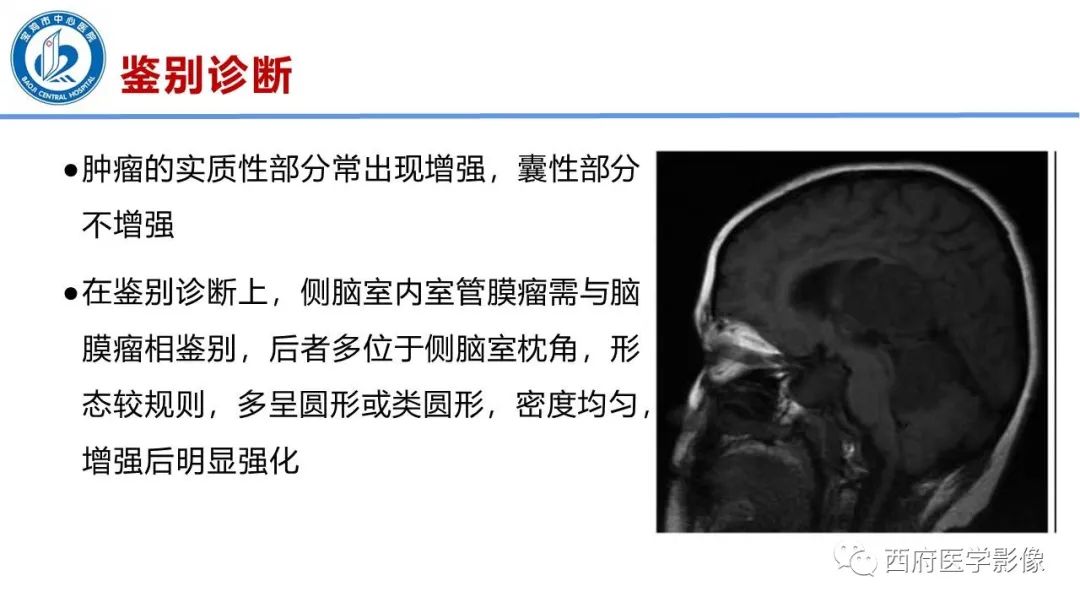 影像PPT - 【病例】脑室系统脑膜瘤1例CT及MR影像表现与鉴别-19