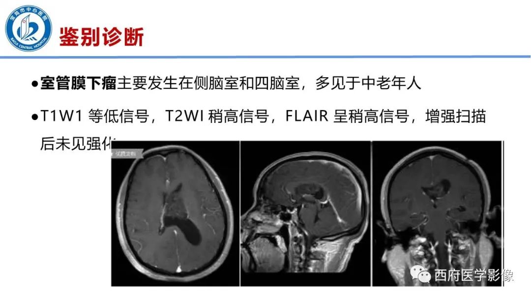 影像PPT - 【病例】脑室系统脑膜瘤1例CT及MR影像表现与鉴别-20
