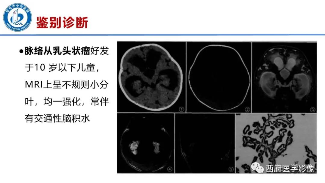 影像PPT - 【病例】脑室系统脑膜瘤1例CT及MR影像表现与鉴别-23
