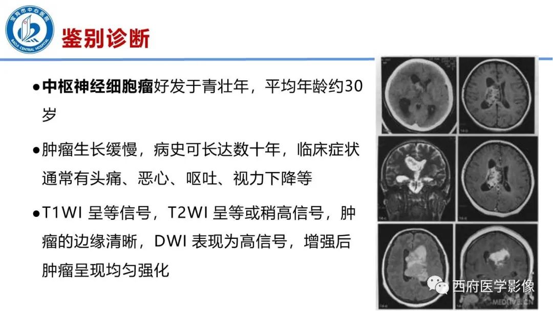 影像PPT - 【病例】脑室系统脑膜瘤1例CT及MR影像表现与鉴别-24