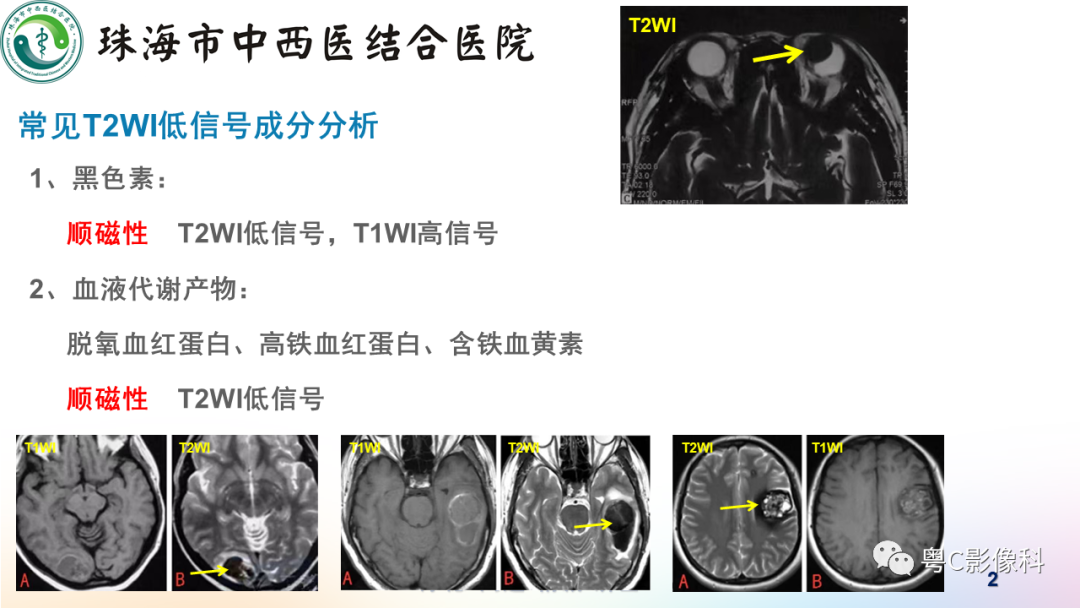 影像PPT - 【PPT】女性附件区T2WI低信号病变影像诊断分析-2