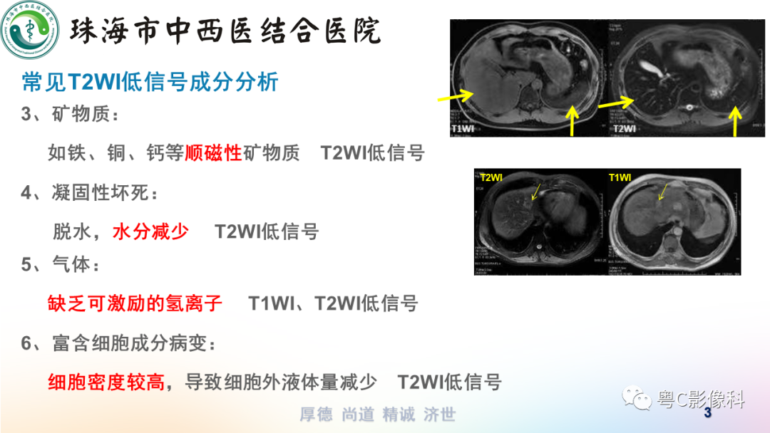 影像PPT - 【PPT】女性附件区T2WI低信号病变影像诊断分析-3