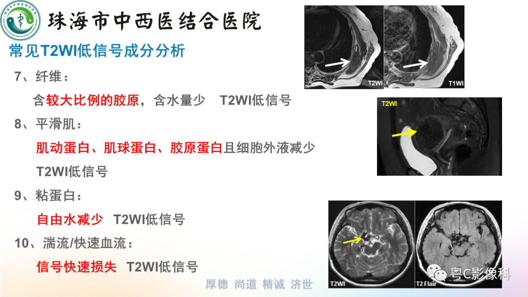 影像PPT - 【PPT】女性附件区T2WI低信号病变影像诊断分析-4