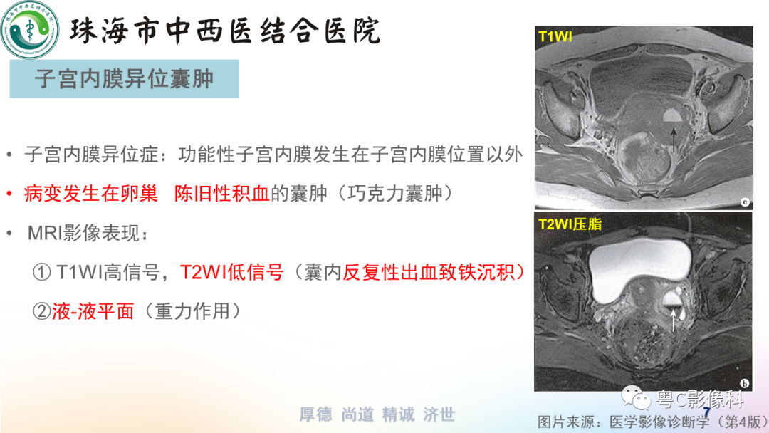 影像PPT - 【PPT】女性附件区T2WI低信号病变影像诊断分析-7