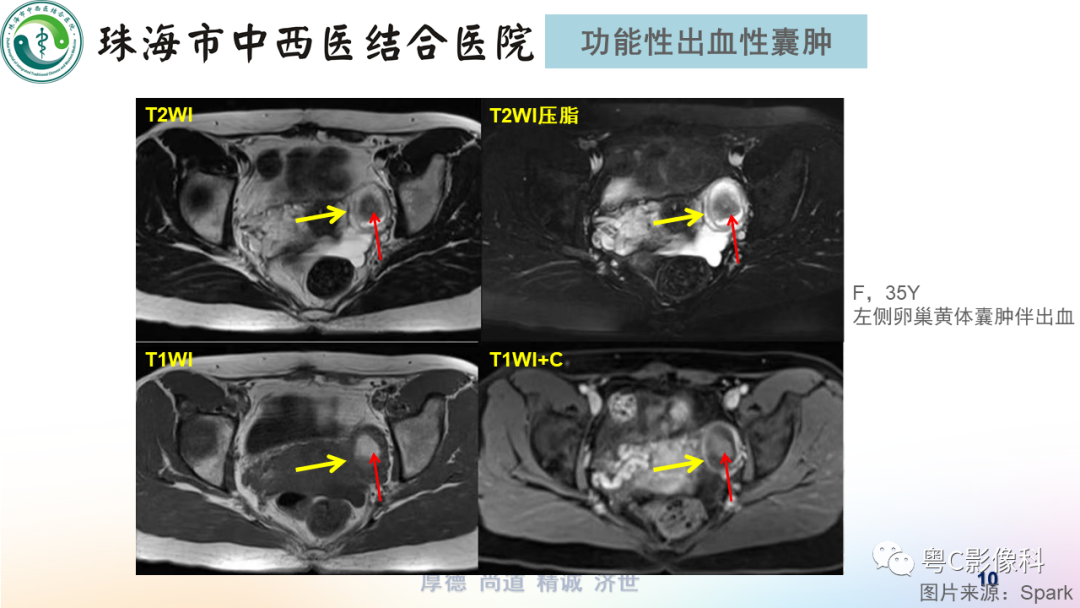 影像PPT - 【PPT】女性附件区T2WI低信号病变影像诊断分析-10