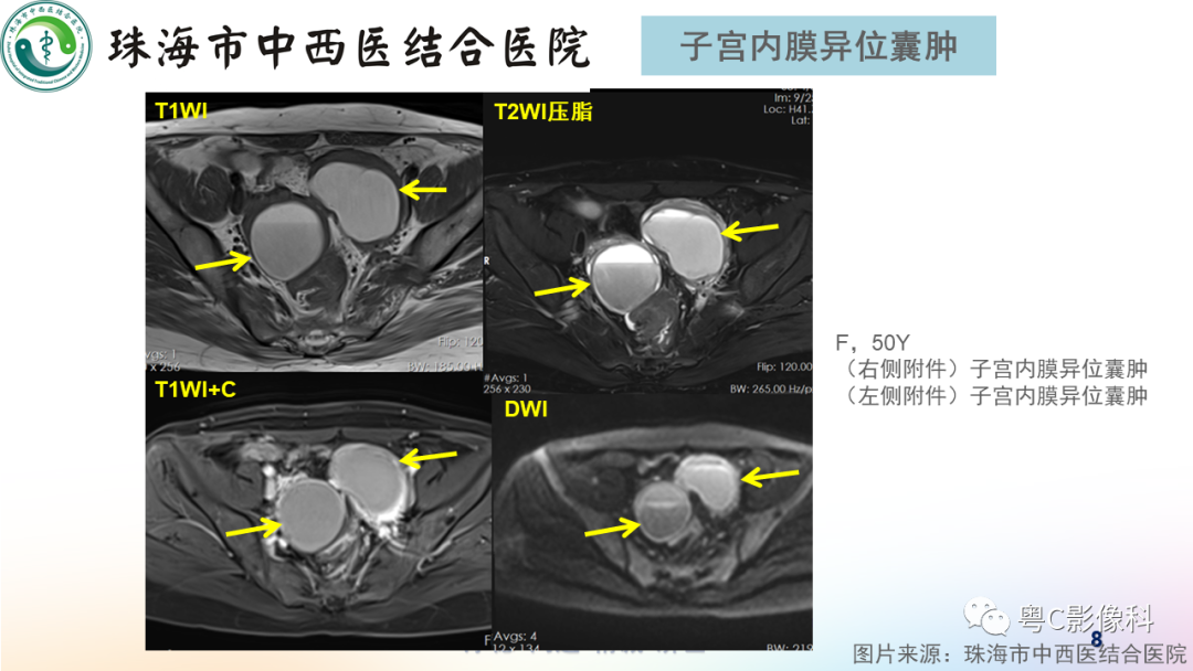 影像PPT - 【PPT】女性附件区T2WI低信号病变影像诊断分析-8