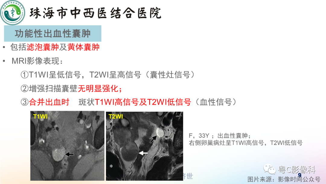 影像PPT - 【PPT】女性附件区T2WI低信号病变影像诊断分析-9