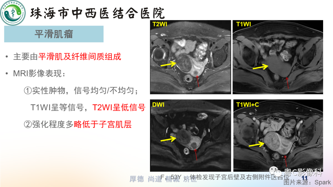 影像PPT - 【PPT】女性附件区T2WI低信号病变影像诊断分析-11