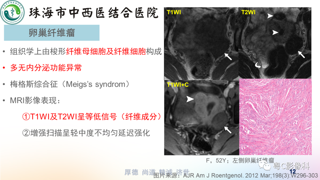 影像PPT - 【PPT】女性附件区T2WI低信号病变影像诊断分析-12