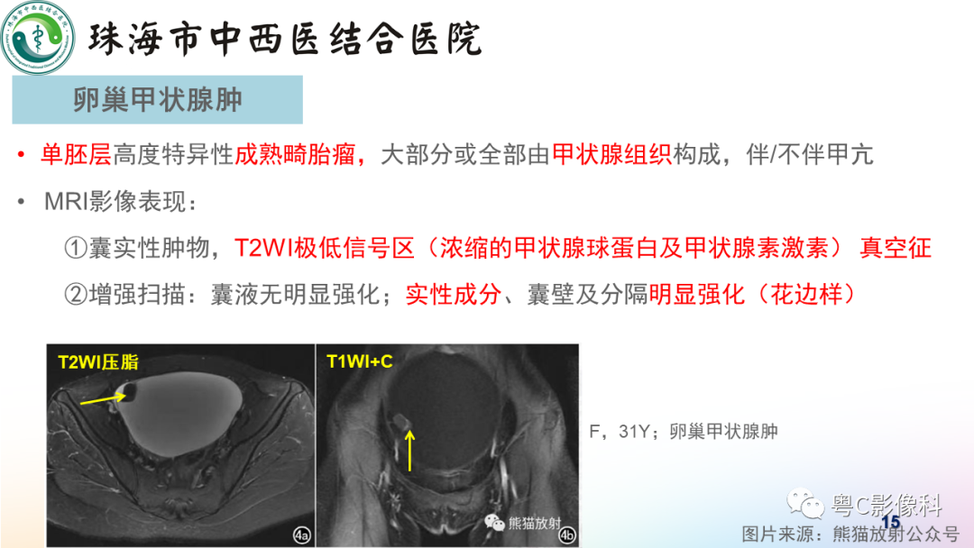 影像PPT - 【PPT】女性附件区T2WI低信号病变影像诊断分析-15