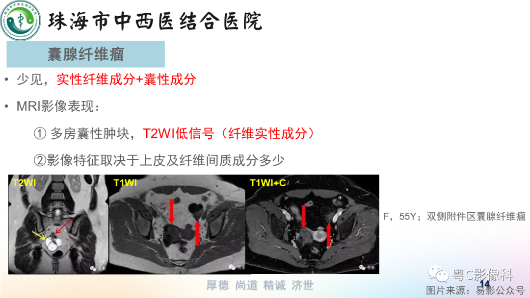 影像PPT - 【PPT】女性附件区T2WI低信号病变影像诊断分析-14