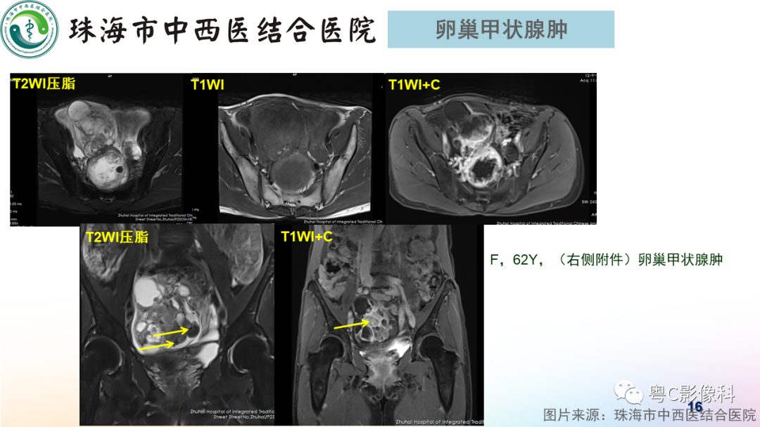 影像PPT - 【PPT】女性附件区T2WI低信号病变影像诊断分析-16
