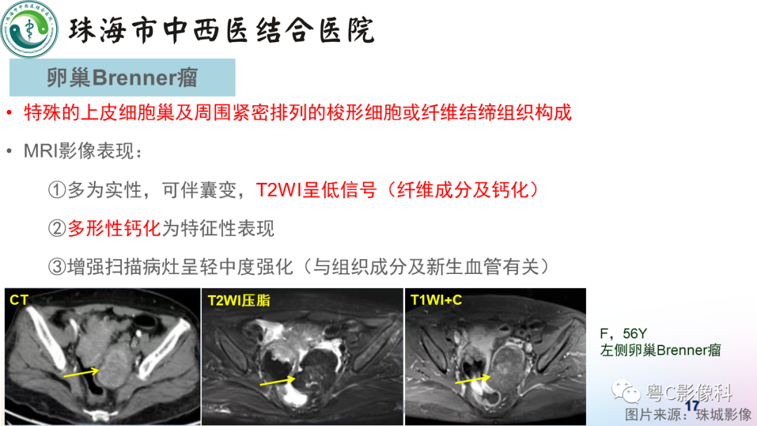 影像PPT - 【PPT】女性附件区T2WI低信号病变影像诊断分析-17