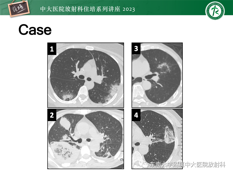 影像PPT - 【PPT】 胸部“反晕征”相关病变及鉴别-1