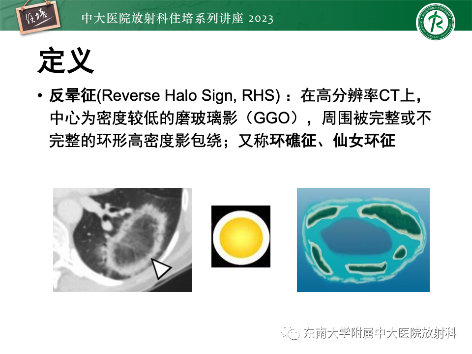 影像PPT - 【PPT】 胸部“反晕征”相关病变及鉴别-3