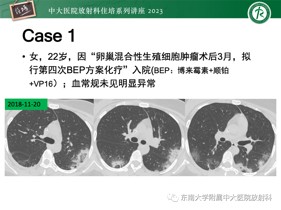 影像PPT - 【PPT】 胸部“反晕征”相关病变及鉴别-5