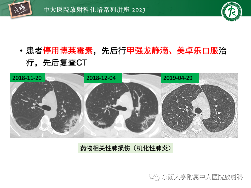 影像PPT - 【PPT】 胸部“反晕征”相关病变及鉴别-6