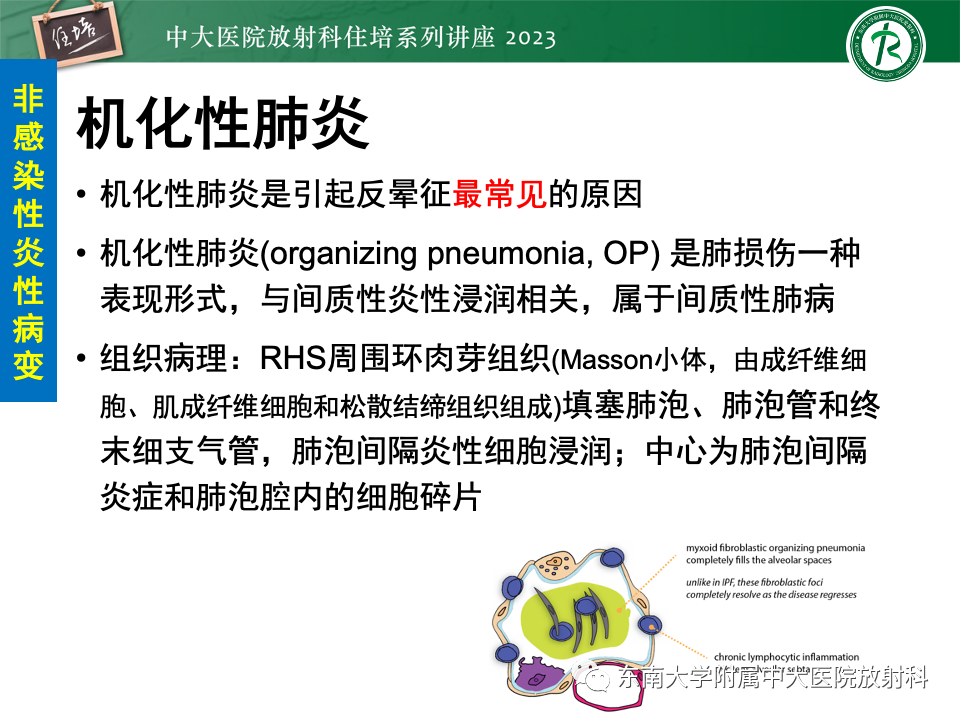 影像PPT - 【PPT】 胸部“反晕征”相关病变及鉴别-7