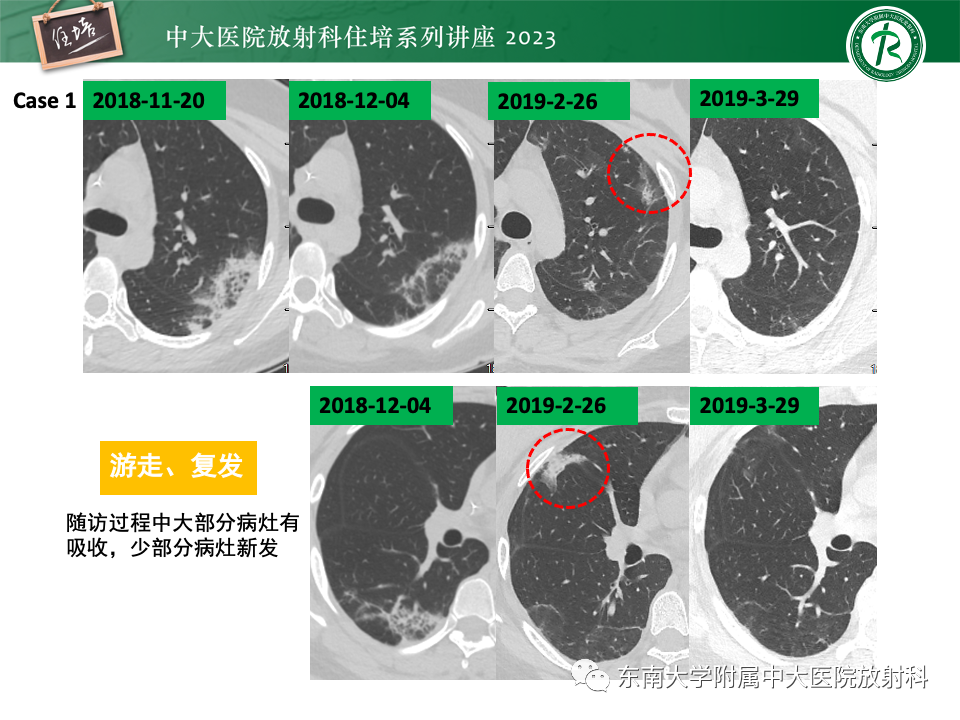 影像PPT - 【PPT】 胸部“反晕征”相关病变及鉴别-10