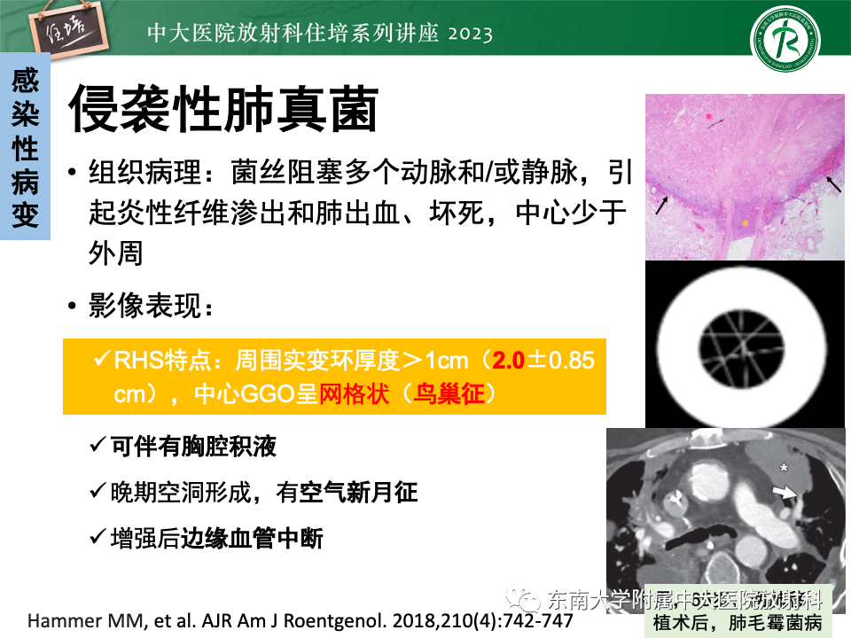 影像PPT - 【PPT】 胸部“反晕征”相关病变及鉴别-16