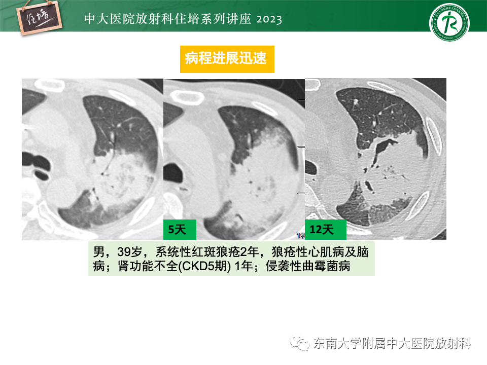 影像PPT - 【PPT】 胸部“反晕征”相关病变及鉴别-17