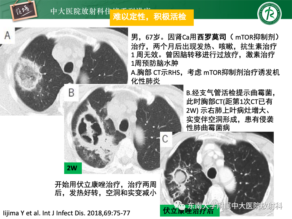 影像PPT - 【PPT】 胸部“反晕征”相关病变及鉴别-18