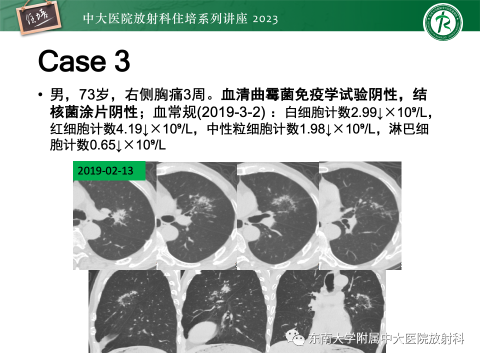 影像PPT - 【PPT】 胸部“反晕征”相关病变及鉴别-27
