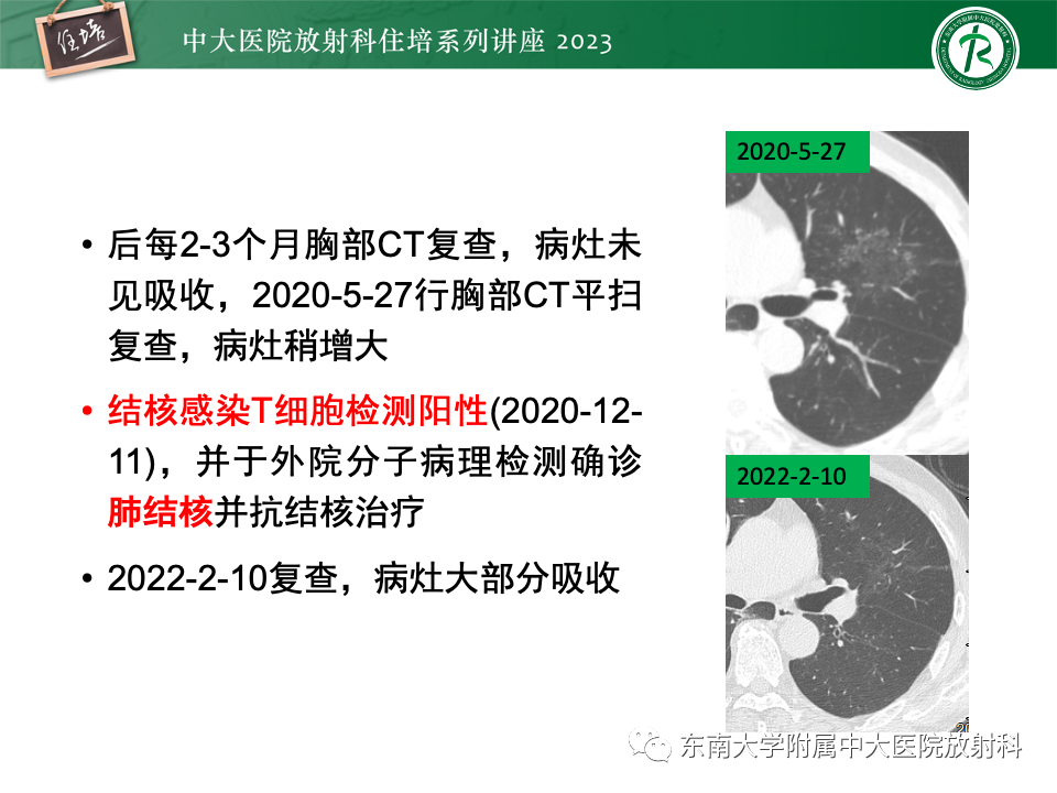 影像PPT - 【PPT】 胸部“反晕征”相关病变及鉴别-28