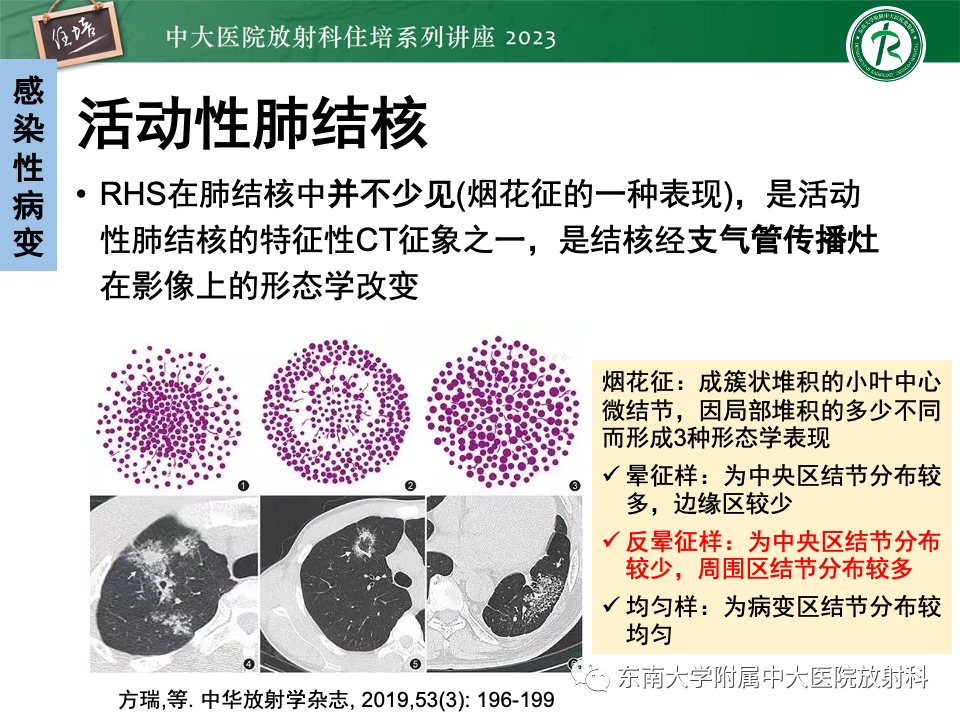 影像PPT - 【PPT】 胸部“反晕征”相关病变及鉴别-29