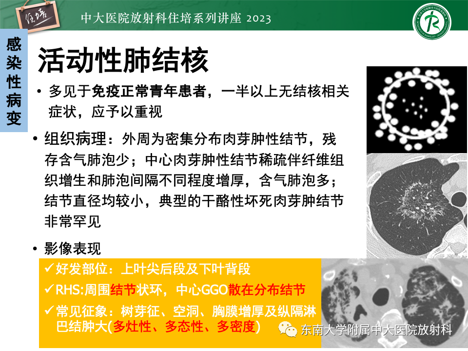 影像PPT - 【PPT】 胸部“反晕征”相关病变及鉴别-30
