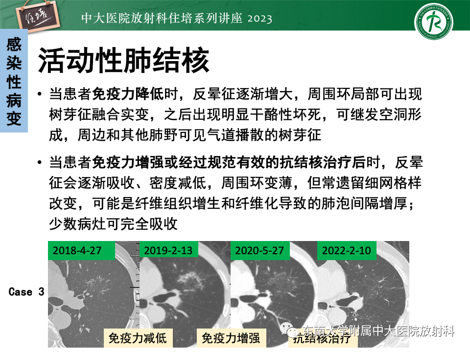 影像PPT - 【PPT】 胸部“反晕征”相关病变及鉴别-31