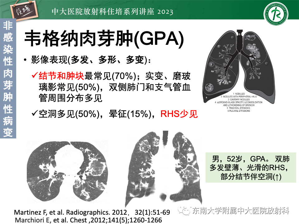 影像PPT - 【PPT】 胸部“反晕征”相关病变及鉴别-34