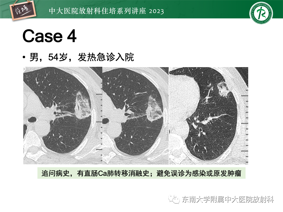 影像PPT - 【PPT】 胸部“反晕征”相关病变及鉴别-38