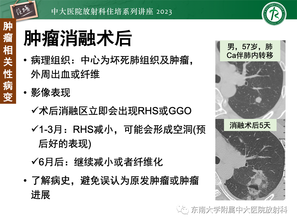 影像PPT - 【PPT】 胸部“反晕征”相关病变及鉴别-39