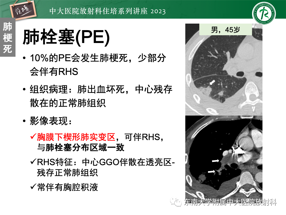 影像PPT - 【PPT】 胸部“反晕征”相关病变及鉴别-37