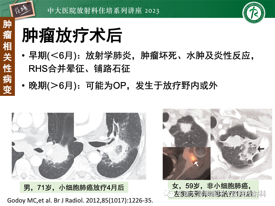影像PPT - 【PPT】 胸部“反晕征”相关病变及鉴别-40