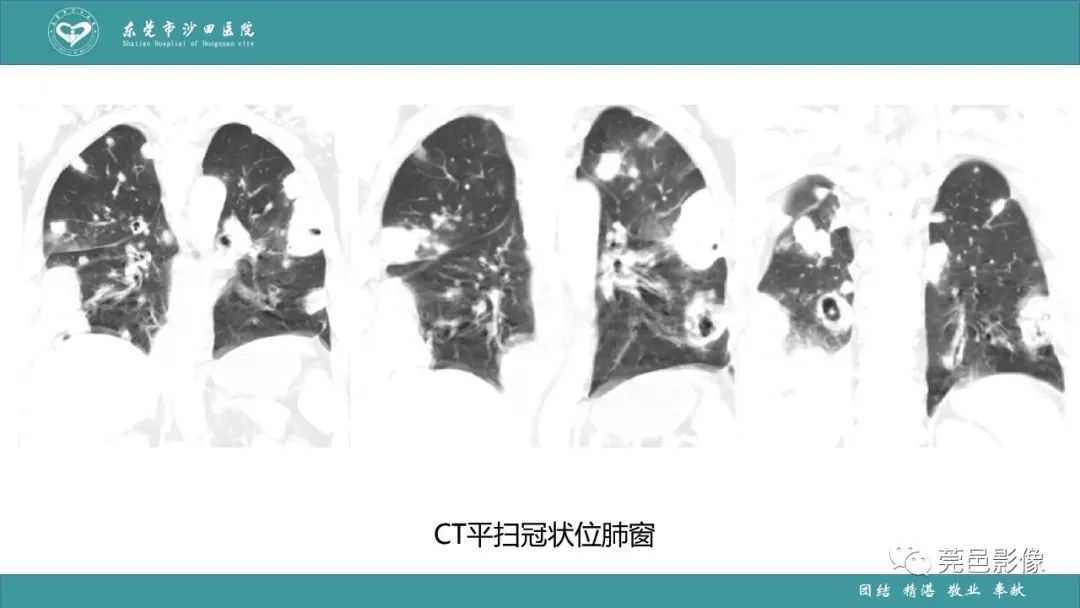 影像PPT - 【PPT】肺炎克雷伯杆菌肺炎影像学诊断与鉴别诊断-8