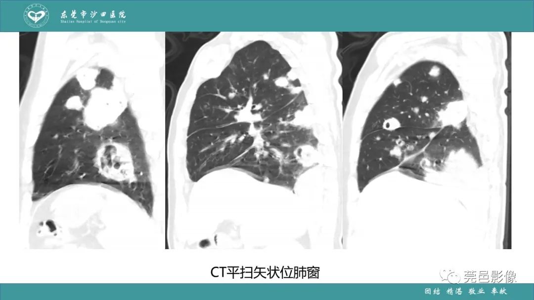 影像PPT - 【PPT】肺炎克雷伯杆菌肺炎影像学诊断与鉴别诊断-9