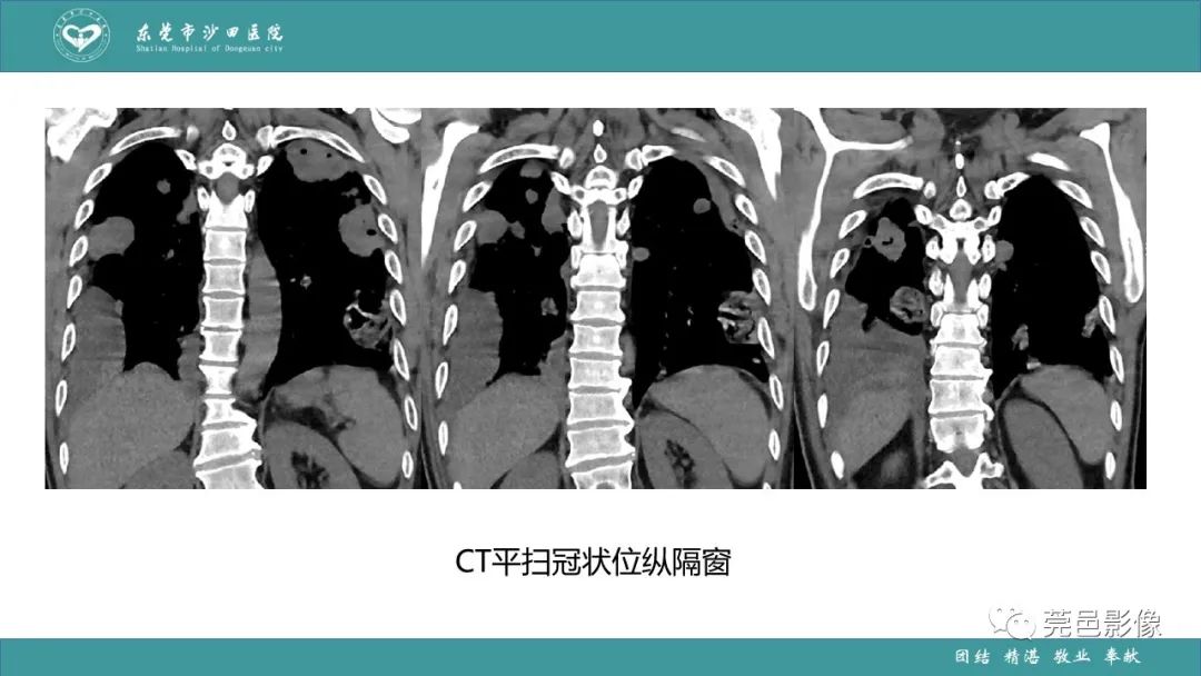 影像PPT - 【PPT】肺炎克雷伯杆菌肺炎影像学诊断与鉴别诊断-10