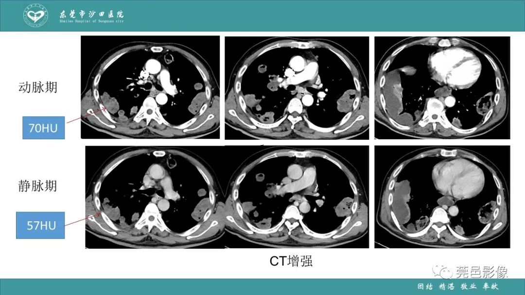 影像PPT - 【PPT】肺炎克雷伯杆菌肺炎影像学诊断与鉴别诊断-11