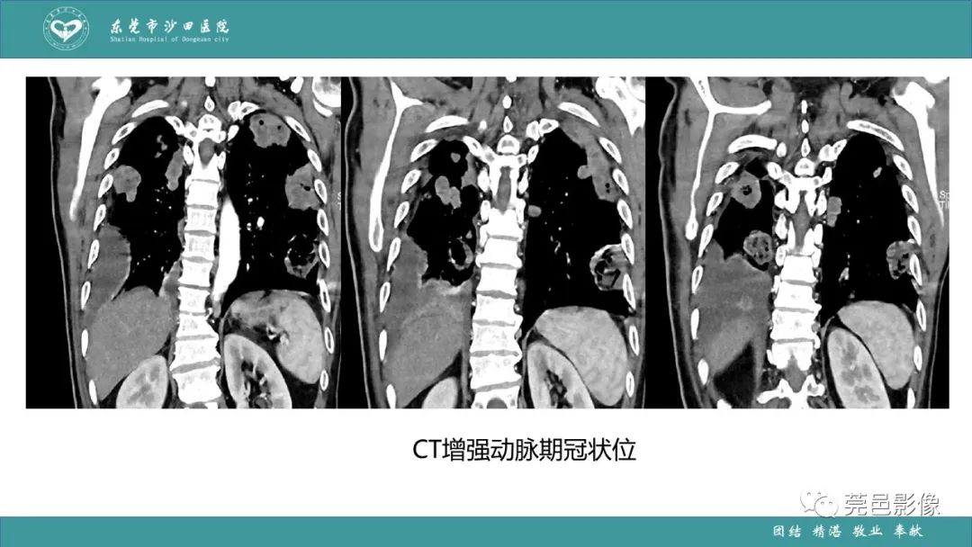 影像PPT - 【PPT】肺炎克雷伯杆菌肺炎影像学诊断与鉴别诊断-12