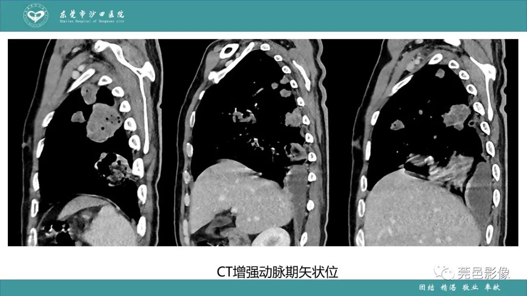 影像PPT - 【PPT】肺炎克雷伯杆菌肺炎影像学诊断与鉴别诊断-13