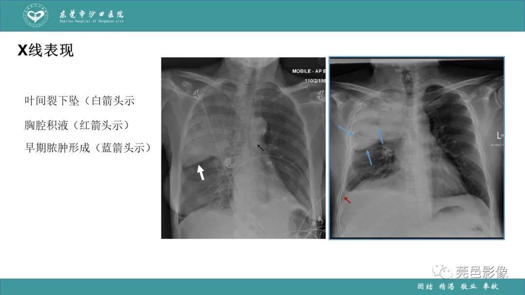 影像PPT - 【PPT】肺炎克雷伯杆菌肺炎影像学诊断与鉴别诊断-25